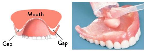 Why do you need denture reline periodically?